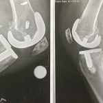Cesmat – Double Knee Replacement a Year Later